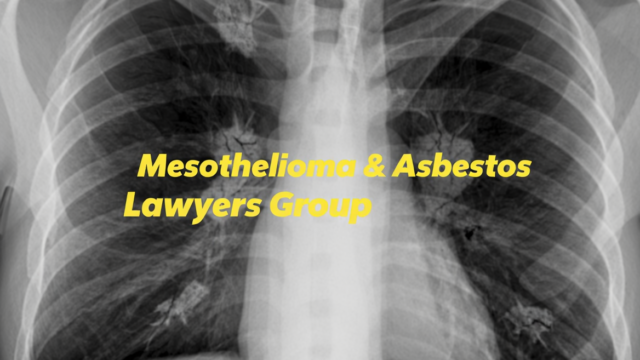 Mesothelioma & Asbestos Lawyers Group of Wisconsin